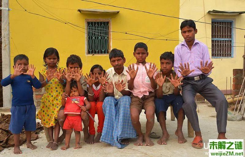 印度一家族人人有12根手指和脚趾